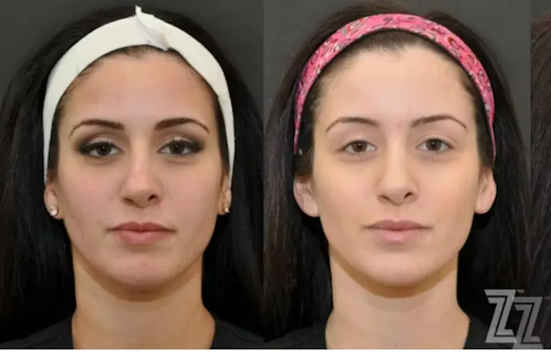 Austin VI Peel Before & After Gallery - Patient 367994 - Image 1 - The Piazza Center