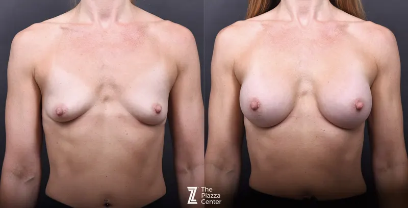 Austin Breast Augmentation Before & After Gallery - Patient 428919 - Image 1 - The Piazza Center