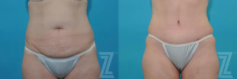 Austin Tummy Tuck Before & After Gallery - Patient 132886874 - Image 1 - The Piazza Center