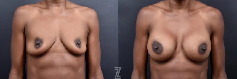 Austin Bilateral before and after view of 33 year old athletic mom of two children breast augmentation - The Piazza Center