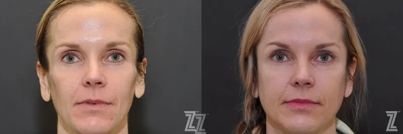 Austin Sculptra® Before & After Gallery - Patient 132963136 - Image 1 - The Piazza Center