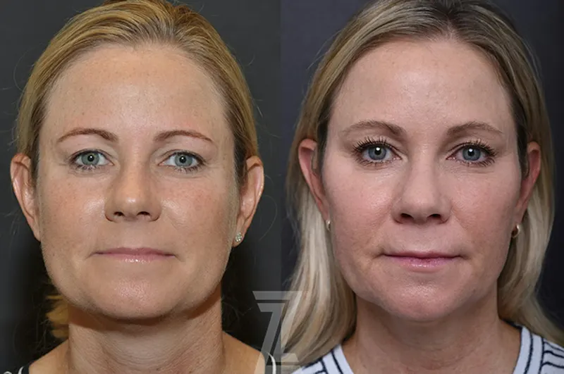 Austin Injectable Fillers Before & After Gallery - Patient 839826 - Image 1 - The Piazza Center