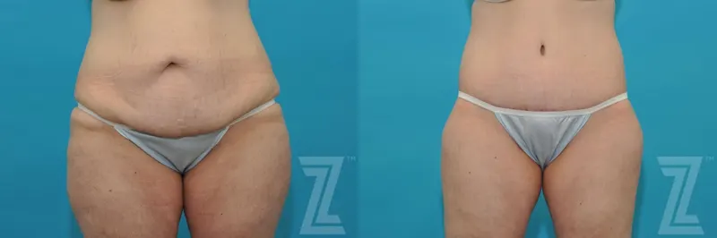Austin Tummy Tuck Before & After Gallery - Patient 132886807 - Image 1 - The Piazza Center