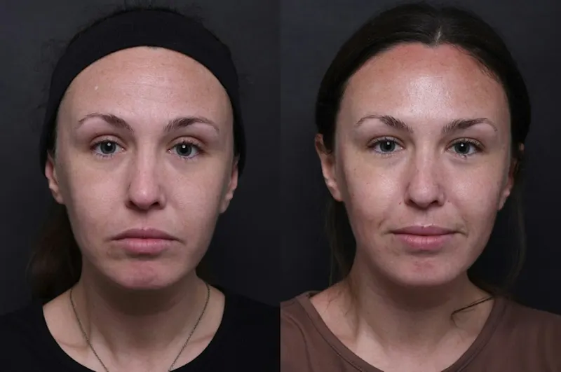 Austin Injectable Fillers Before & After Gallery - Patient 242235 - Image 1 - The Piazza Center