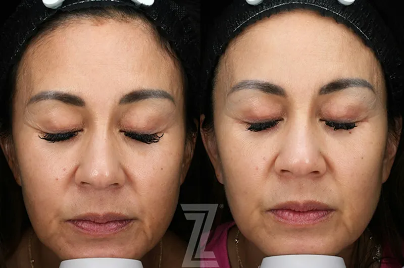 Austin SkinPen Microneedling Before & After Gallery - Patient 324647 - Image 1 - The Piazza Center