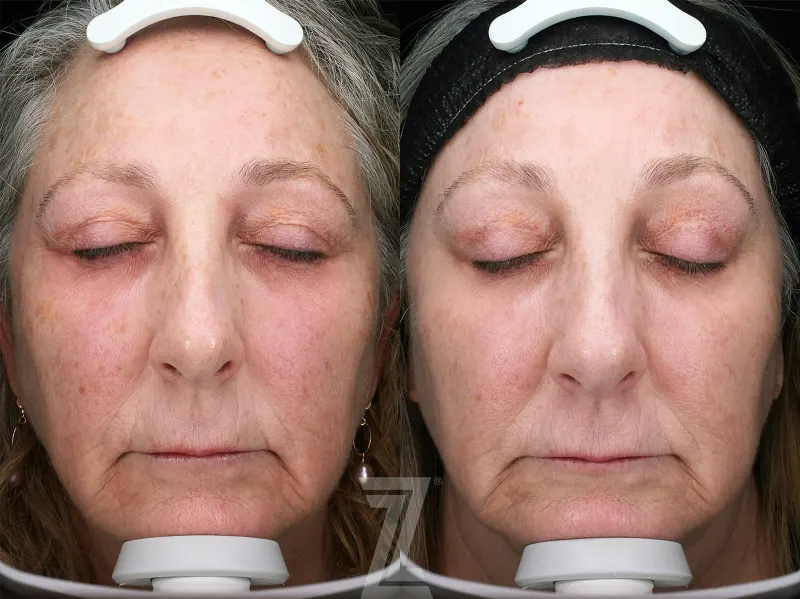 Austin HALO Before & After Gallery - Patient 192175 - Image 1 - The Piazza Center