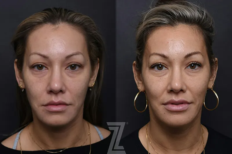 Austin Injectable Fillers Before & After Gallery - Patient 407560 - Image 1 - The Piazza Center