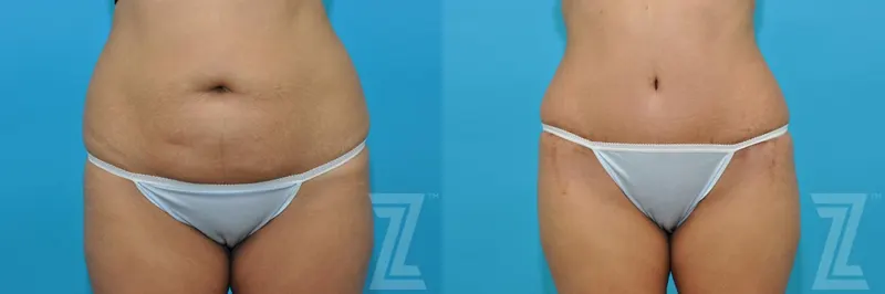 Austin Tummy Tuck Before & After Gallery - Patient 132886811 - Image 1 - The Piazza Center