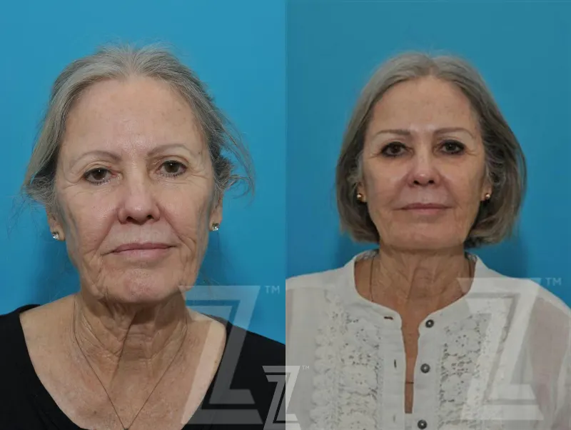 Austin Sculptra® Before & After Gallery - Patient 132963132 - Image 1 - The Piazza Center