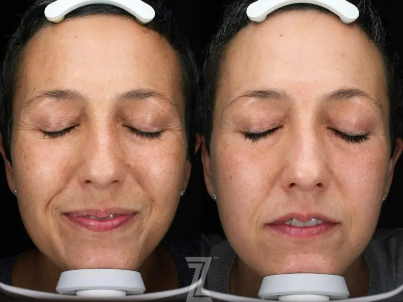 Austin HALO Before & After Gallery - Patient 386324 - Image 1 - The Piazza Center