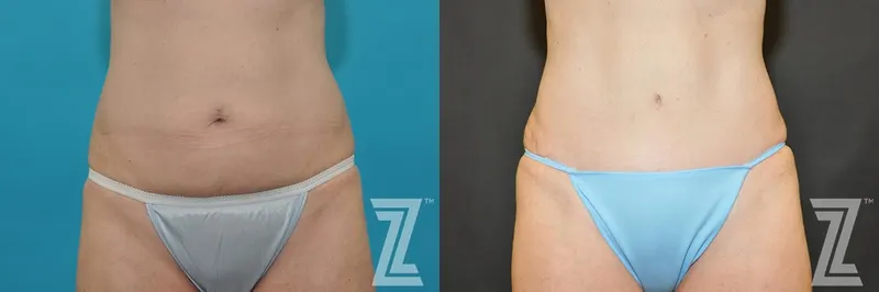 Austin Tummy Tuck Before & After Gallery - Patient 132886891 - Image 1 - The Piazza Center