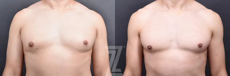 Austin Male Breast Reduction Before & After Gallery - Patient 348353 - Image 1 - The Piazza Center