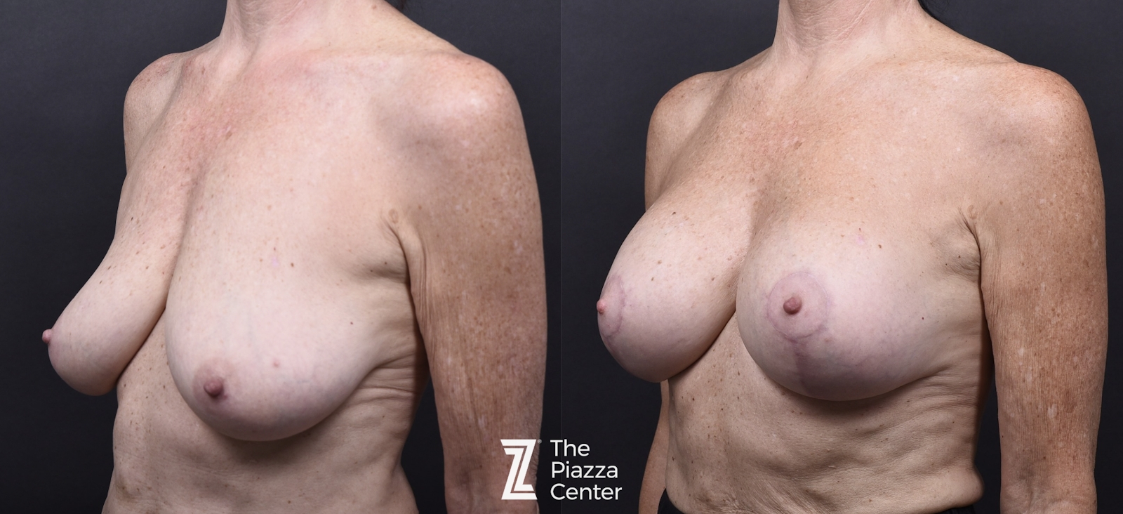 Austin Breast Augmentation Before & After Gallery - Patient 287263 - Image 4 - The Piazza Center