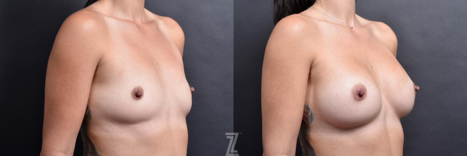 Austin Oblique view before and after image of 35 year old woman with Silicone Implants with Cohesive Silicone Gel - The Piazza Center - The Piazza Center