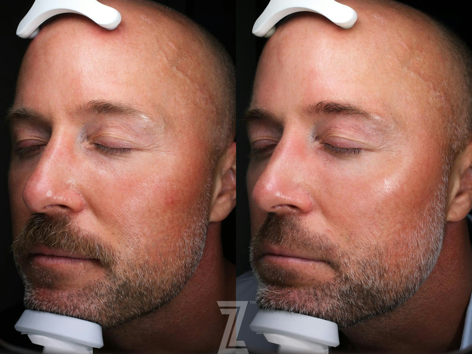 Austin SkinPen Microneedling Before & After Gallery - Patient 394755 - Image 1 - The Piazza Center