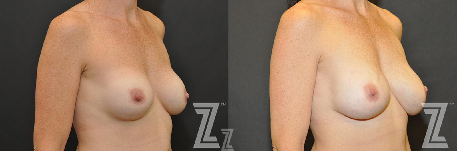 Austin Breast Reconstruction Before & After Gallery - Patient 132886773 - Image 4 - The Piazza Center