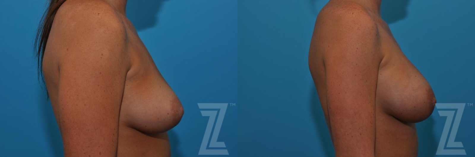 Austin Correction of Breast Asymmetry Before & After Gallery - Patient 132886779 - Image 5 - The Piazza Center