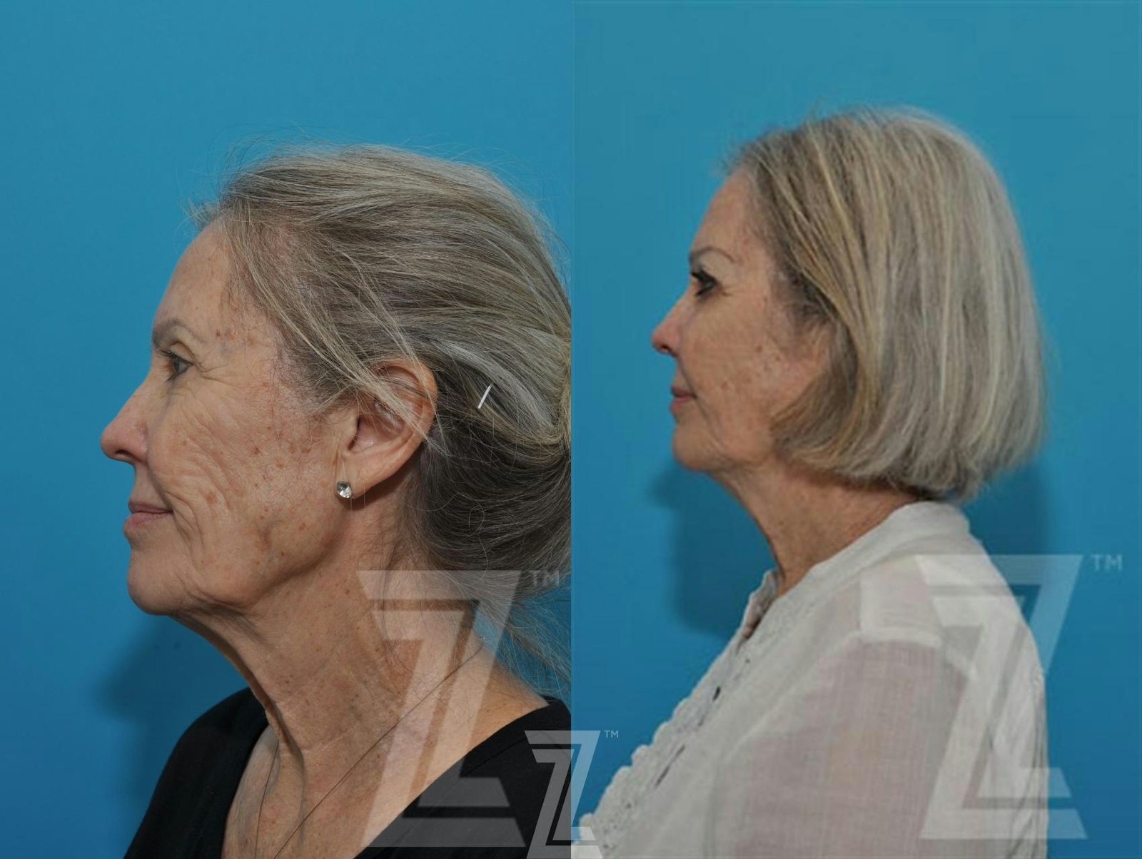 Austin Sculptra® Before & After Gallery - Patient 132963132 - Image 3 - The Piazza Center