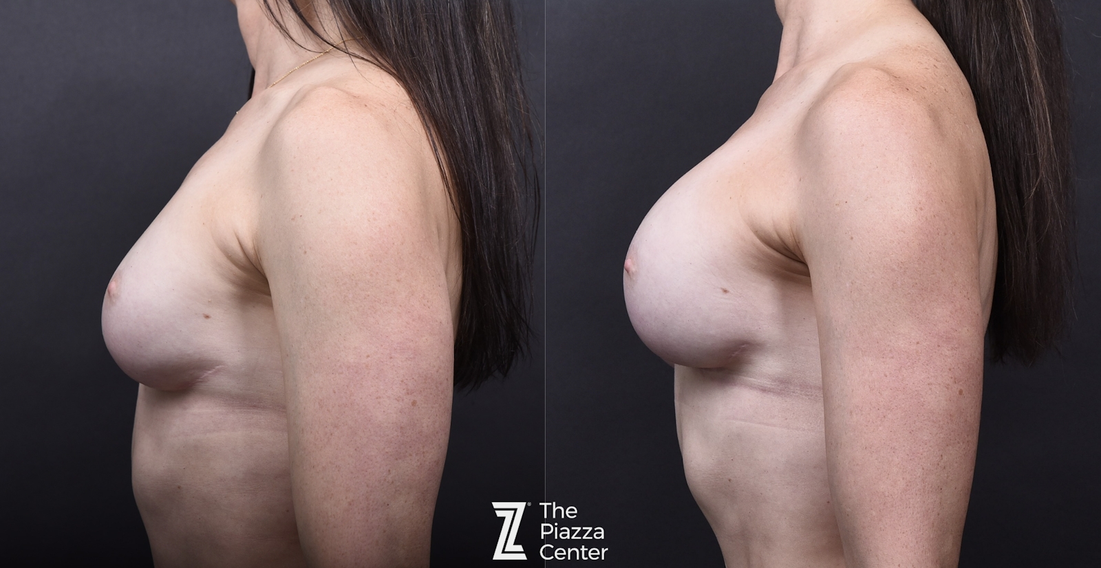 Austin Breast Augmentation Before & After Gallery - Patient 276383 - Image 3 - The Piazza Center