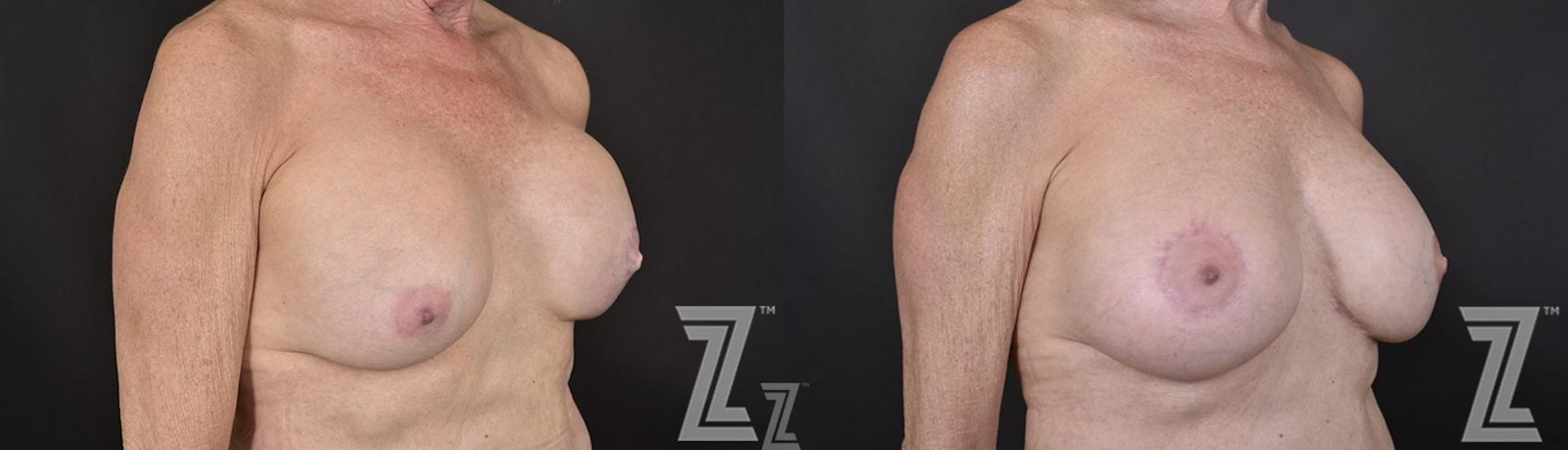 Austin Breast Reconstruction Before & After Gallery - Patient 132886765 - Image 4 - The Piazza Center