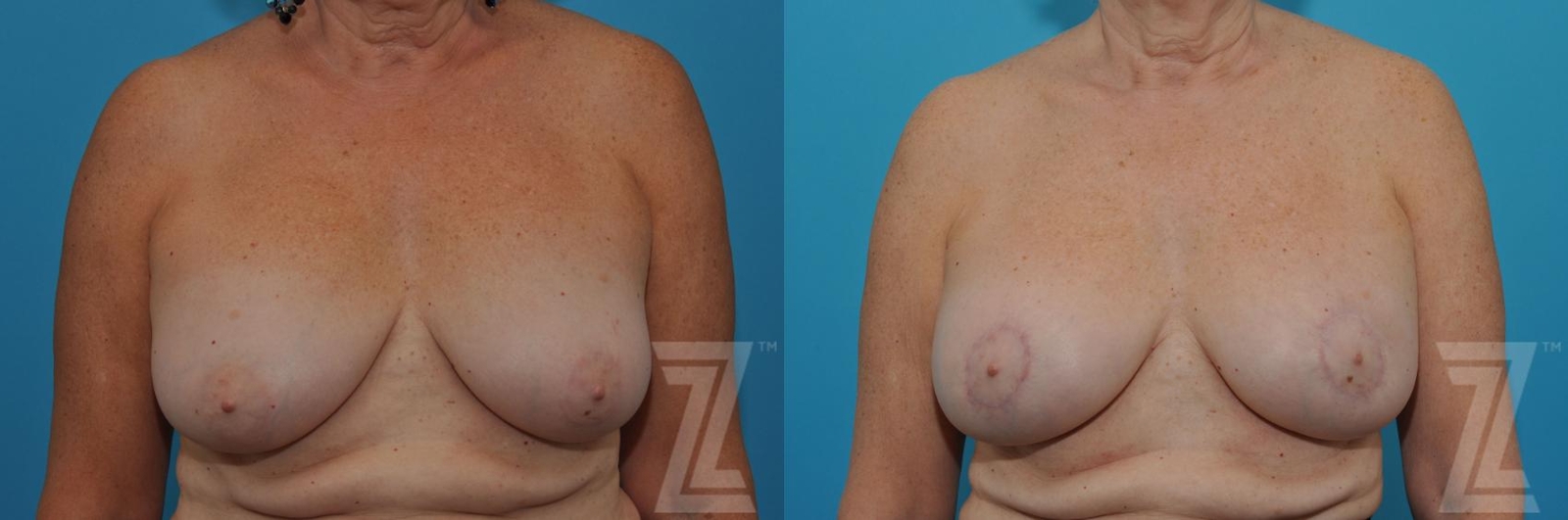 Austin Breast Augmentation Revision Before & After Gallery - Patient 132886586 - Image 1 - The Piazza Center