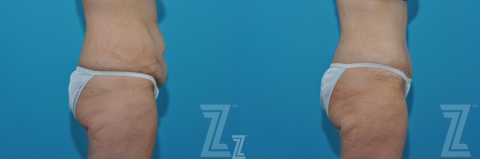 Austin Tummy Tuck Before & After Gallery - Patient 620256 - Image 4 - The Piazza Center