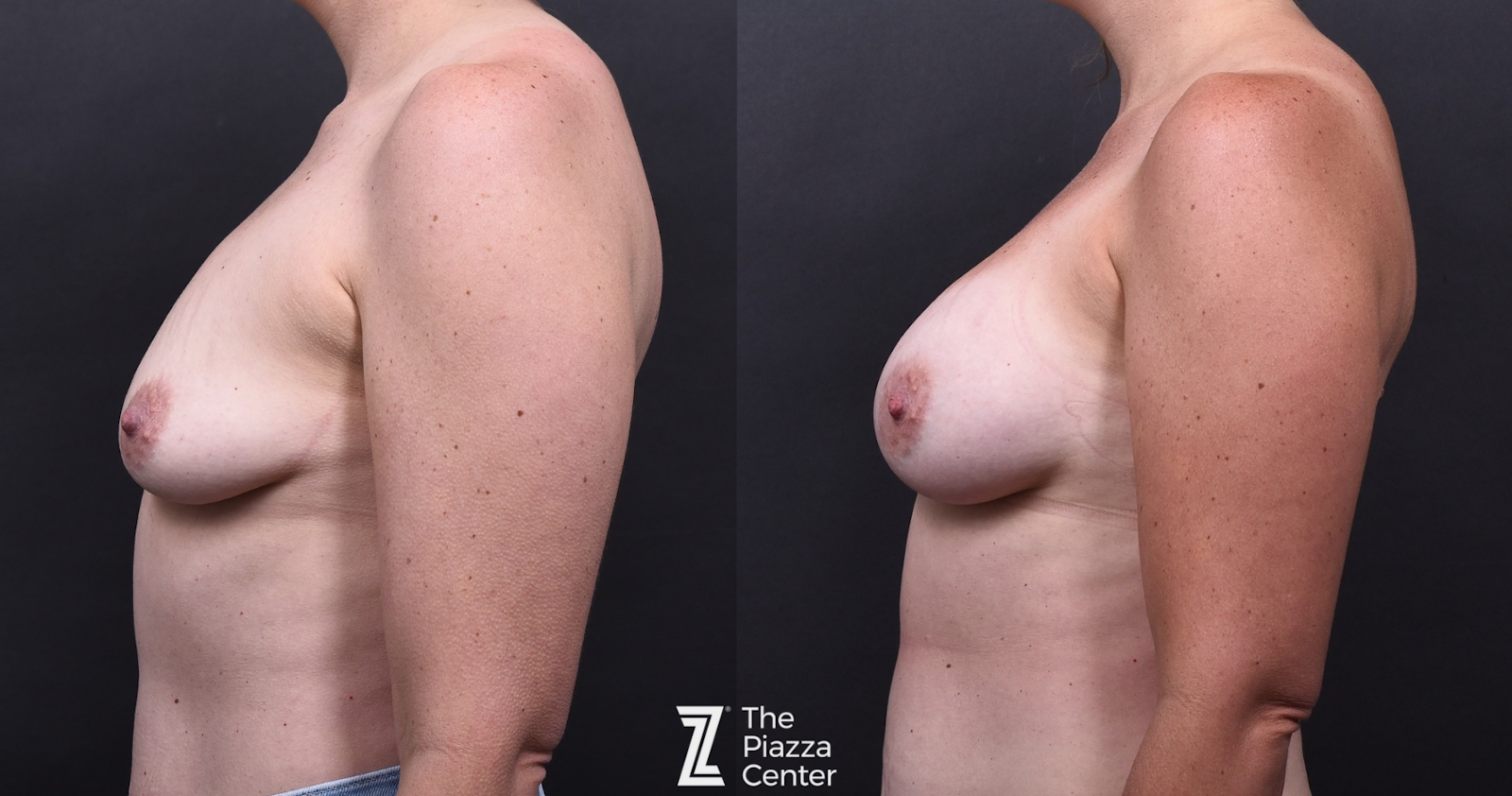 Austin Breast Augmentation Before & After Gallery - Patient 353034 - Image 5 - The Piazza Center