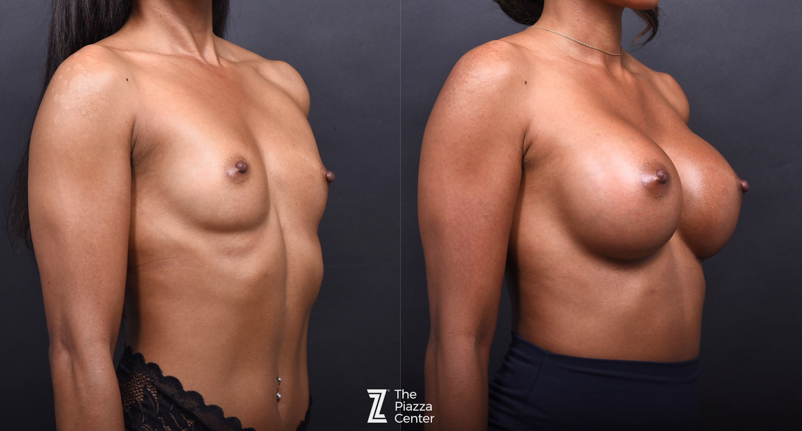 Austin Breast Augmentation Before & After Gallery - Patient 970520 - Image 2 - The Piazza Center