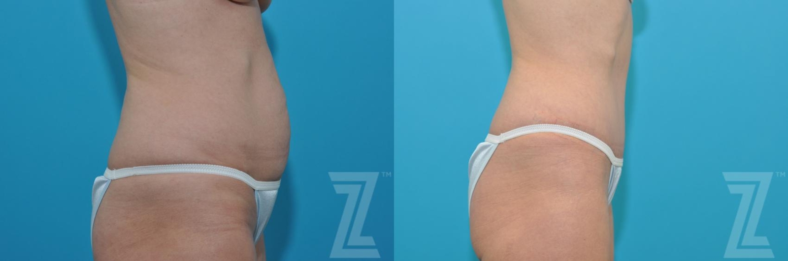 Austin Tummy Tuck Before & After Gallery - Patient 132886905 - Image 4 - The Piazza Center