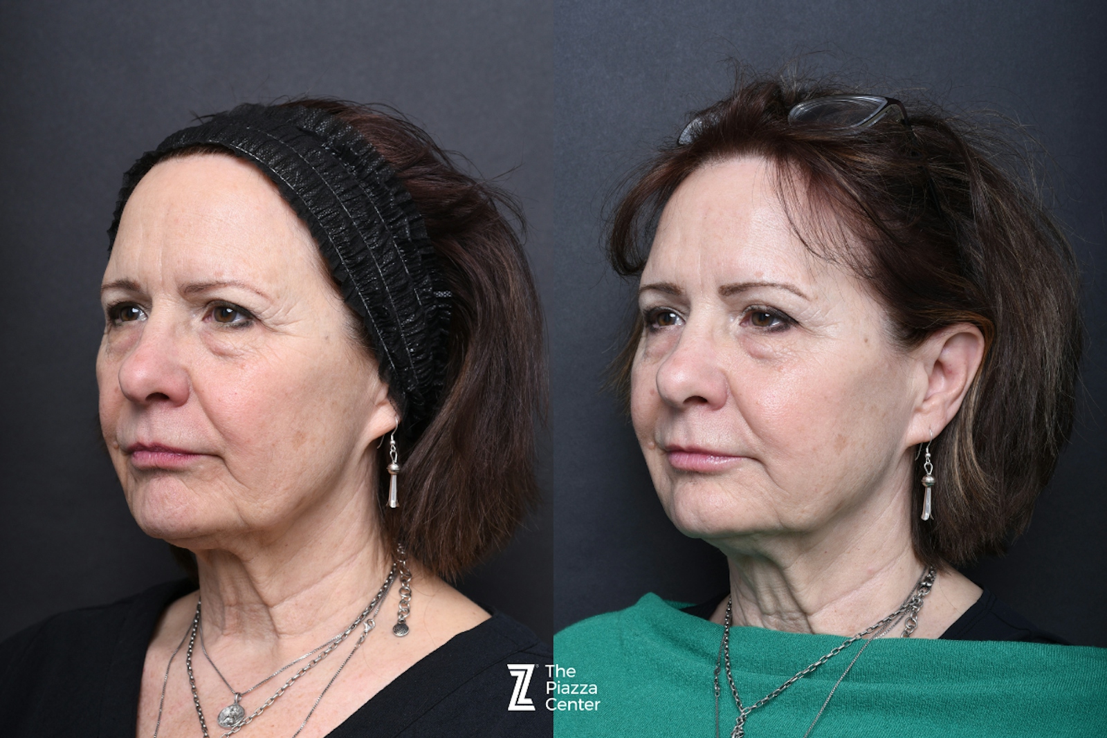 Austin Facial Rejuvenation Before & After Gallery - Patient 999542 - Image 3 - The Piazza Center