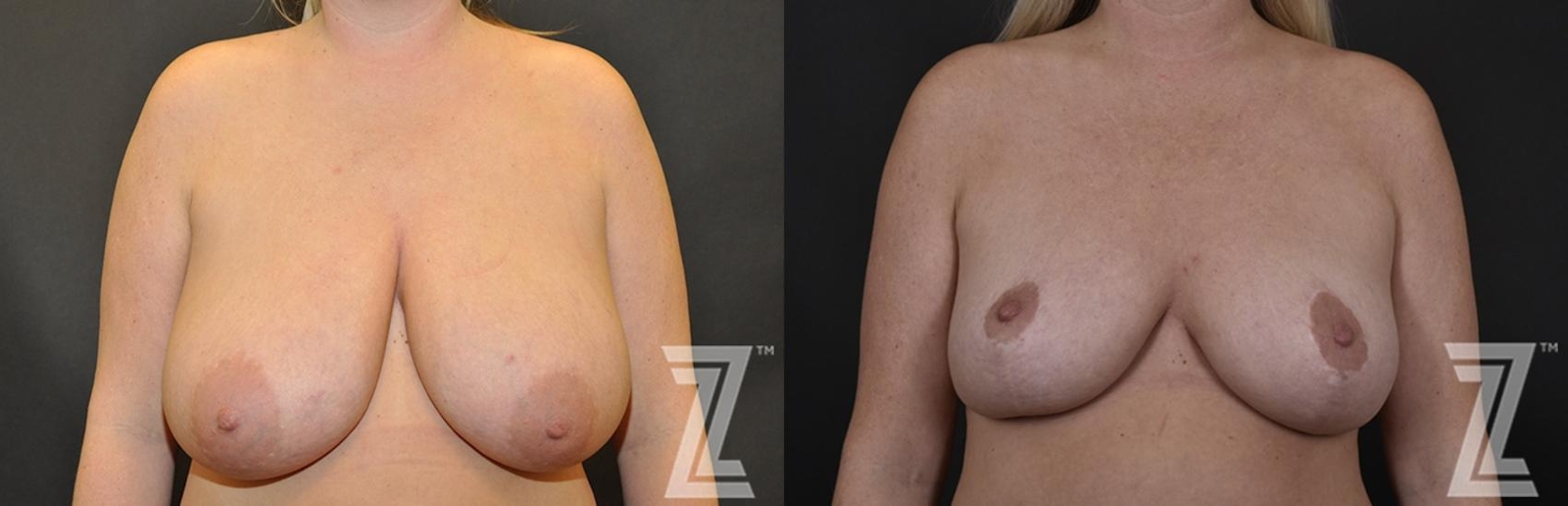 Austin Breast Reduction Before & After Gallery - Patient 132886746 - Image 1 - The Piazza Center
