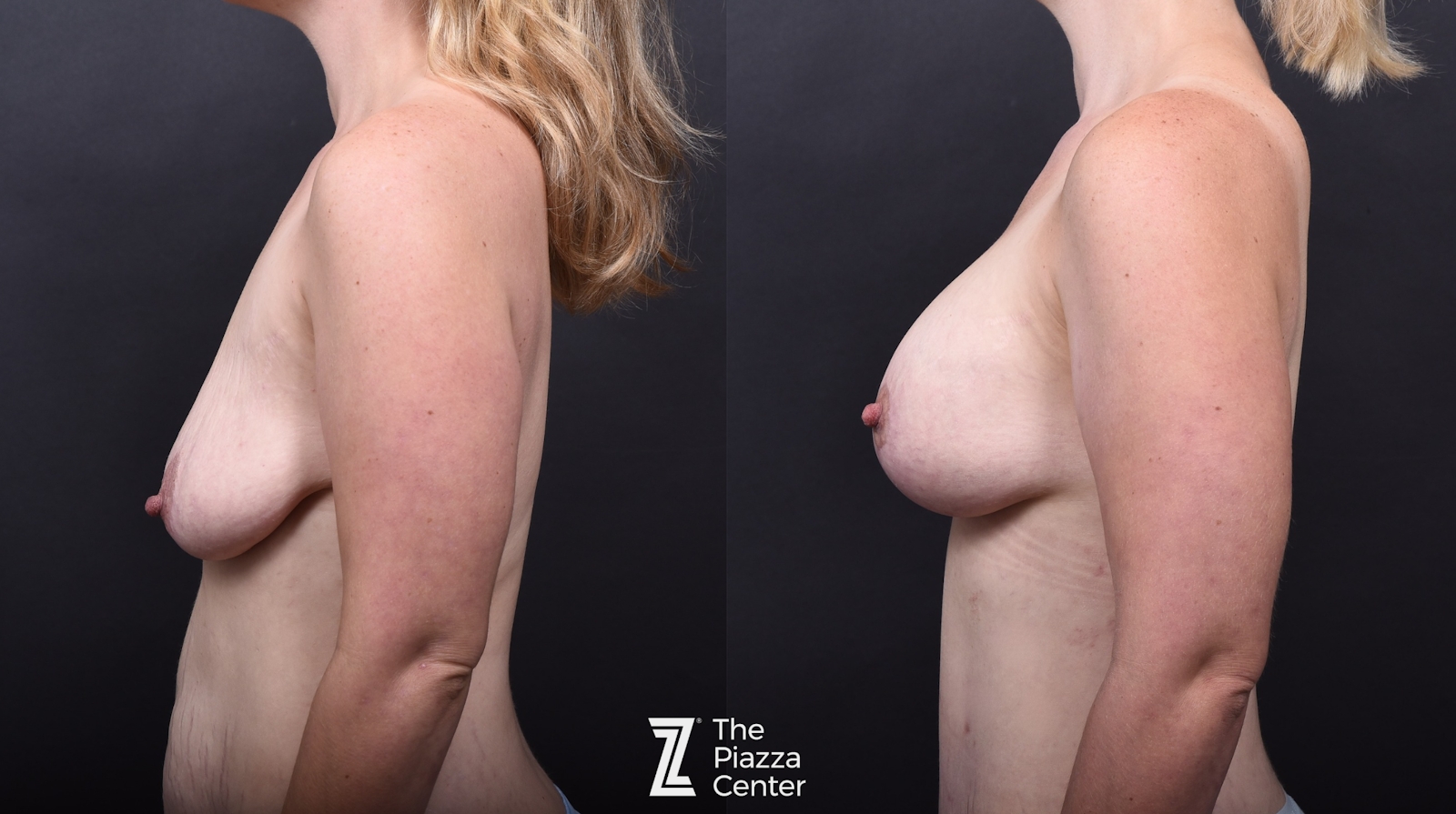 Austin Breast Augmentation Before & After Gallery - Patient 425278 - Image 5 - The Piazza Center