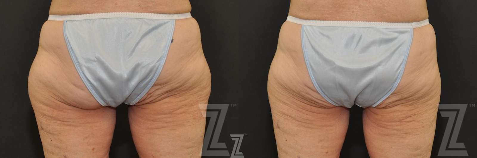 Austin CoolSculpting® Before & After Gallery - Patient 132905389 - Image 1 - The Piazza Center