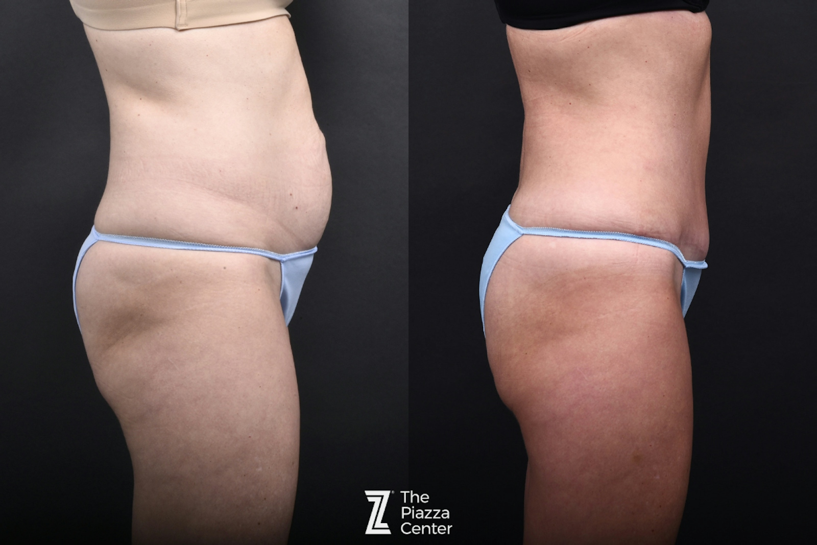 Austin Tummy Tuck Before & After Gallery - Patient 957209 - Image 2 - The Piazza Center