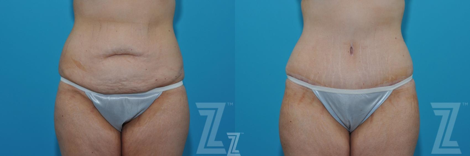Austin Liposuction Before & After Gallery - Patient 132903278 - Image 1 - The Piazza Center