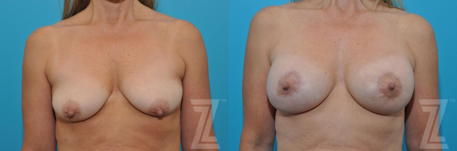 Austin Breast Augmentation With a Breast Lift Before & After Gallery - Patient 132791122 - Image 1 - The Piazza Center