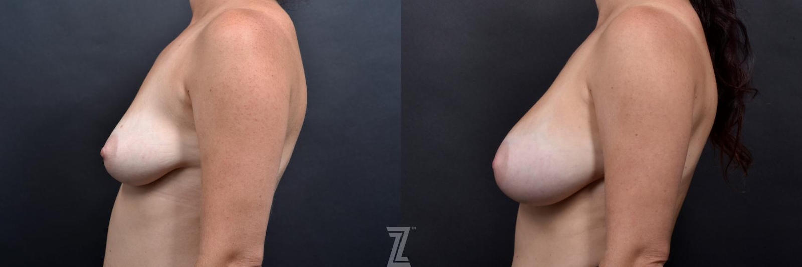 Austin Lateral view of 36 year old woman with Silicone Implants with Cohesive Silicone Gel at the Piazza Center - The Piazza Center