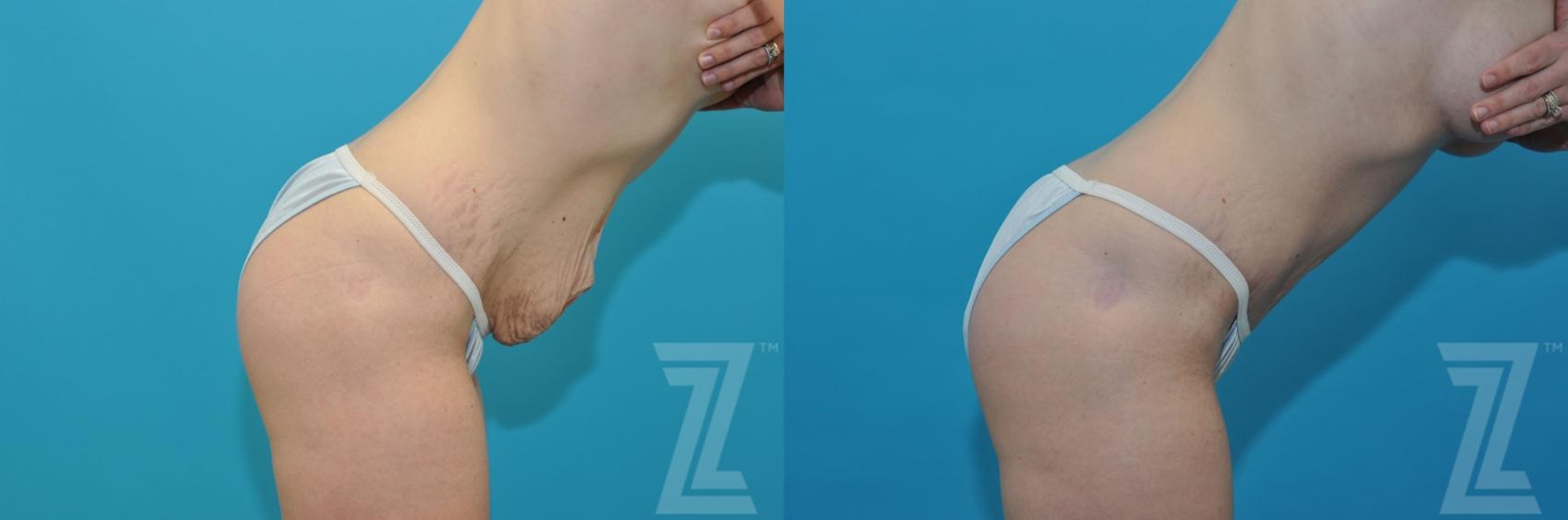 Austin Tummy Tuck Before & After Gallery - Patient 132886867 - Image 5 - The Piazza Center