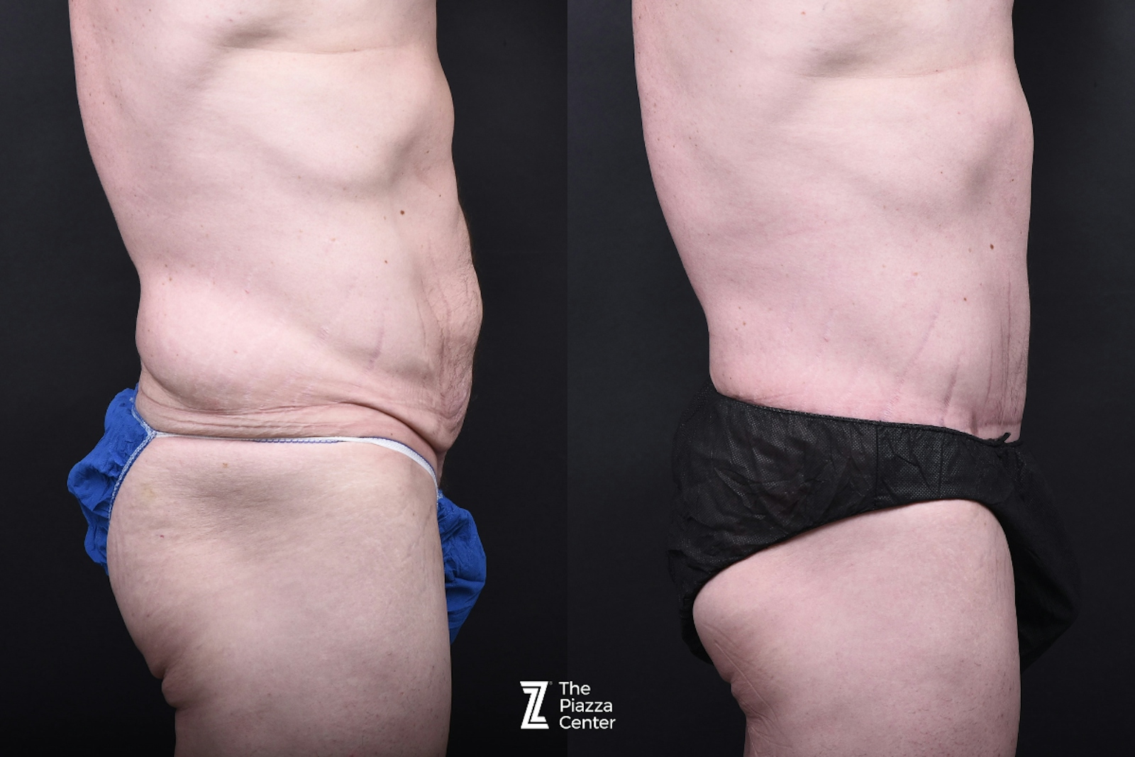 Austin Tummy Tuck Before & After Gallery - Patient 830228 - Image 2 - The Piazza Center