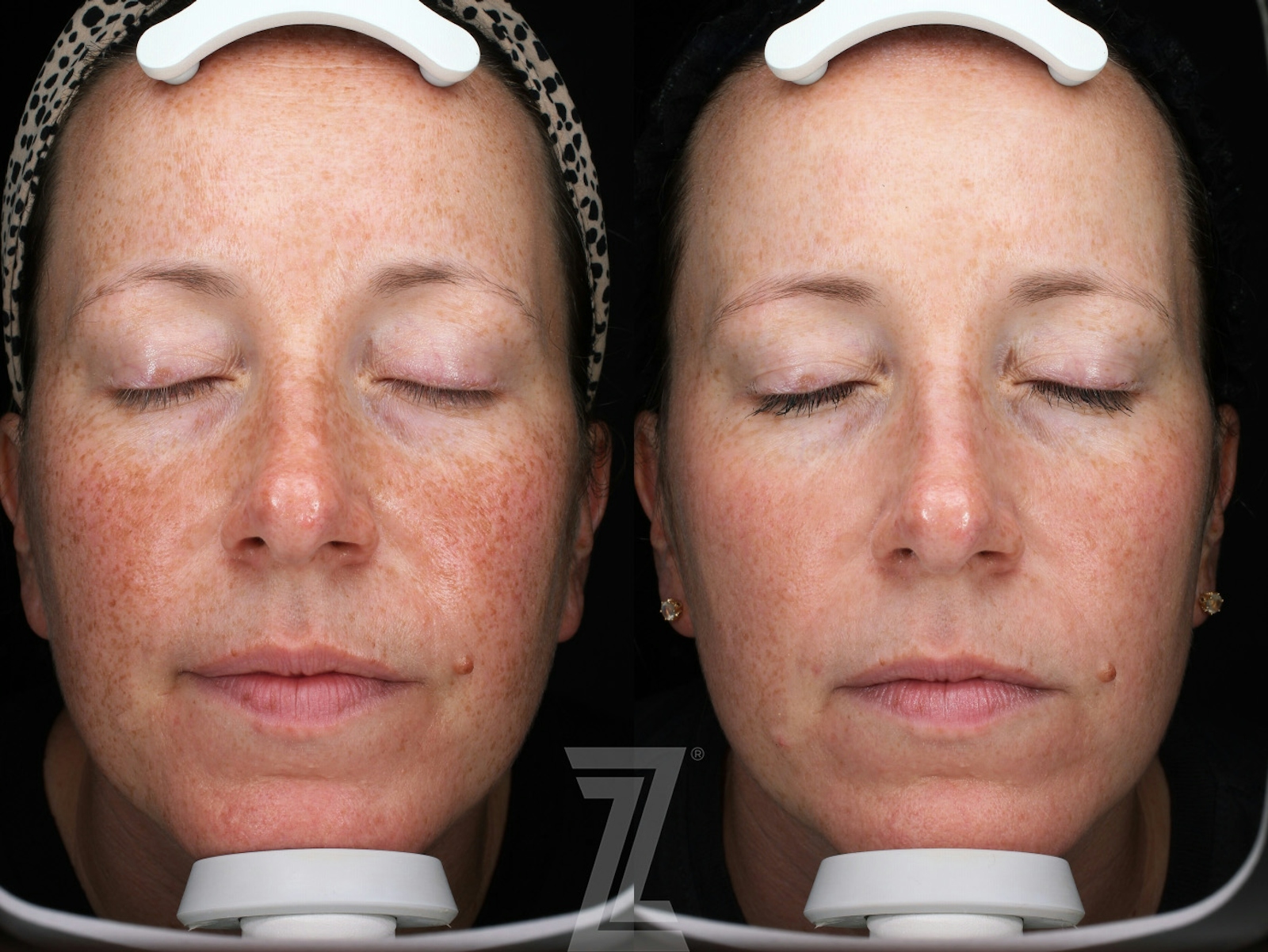 Austin Moxi Before & After Gallery - Patient 355580 - Image 1 - The Piazza Center