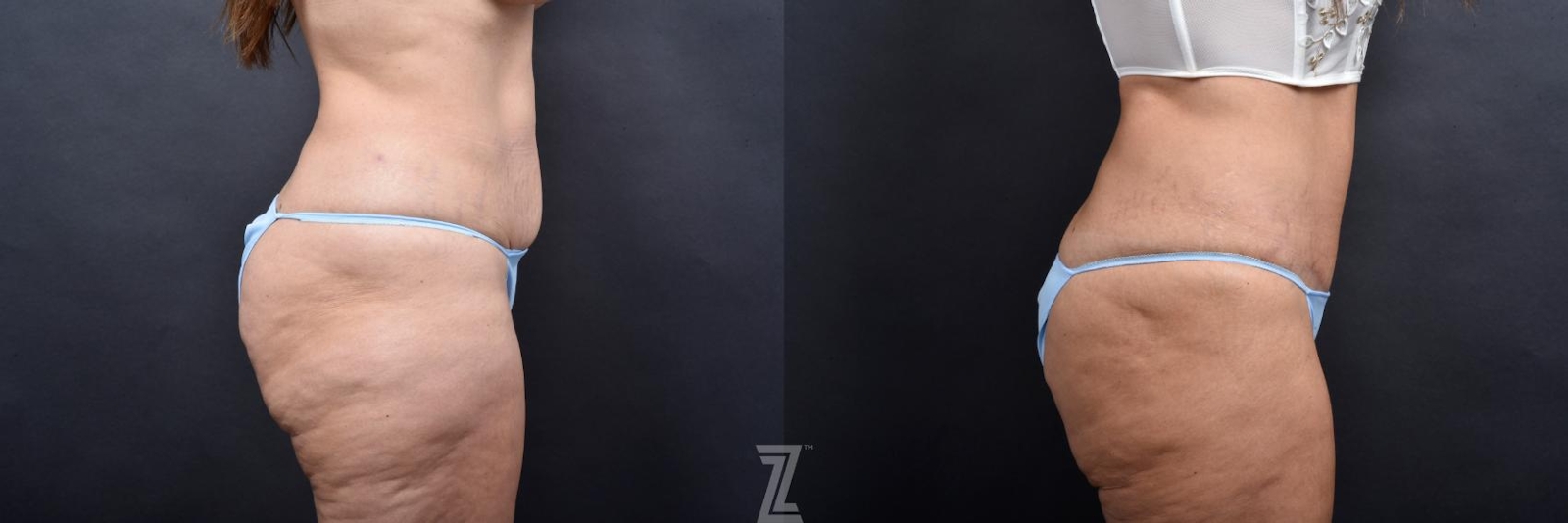 Austin Tummy Tuck Before & After Gallery - Patient 132886877 - Image 3 - The Piazza Center