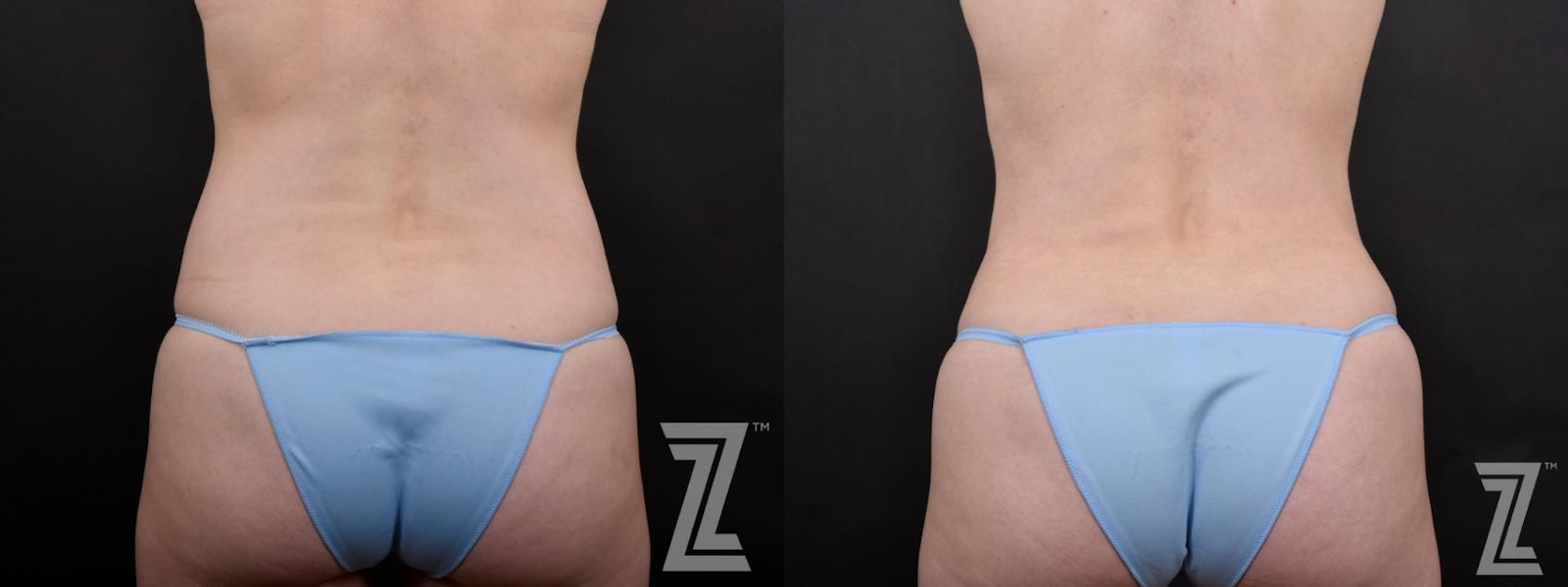 Austin Posterior View from Mommy Makeover with Surgical Plan for a Breast Augmentation and a Contoured Waistline With an Abdominoplasty in Austin, TX by Dr. Rocco Piazza - Before & After - The Piazza Center