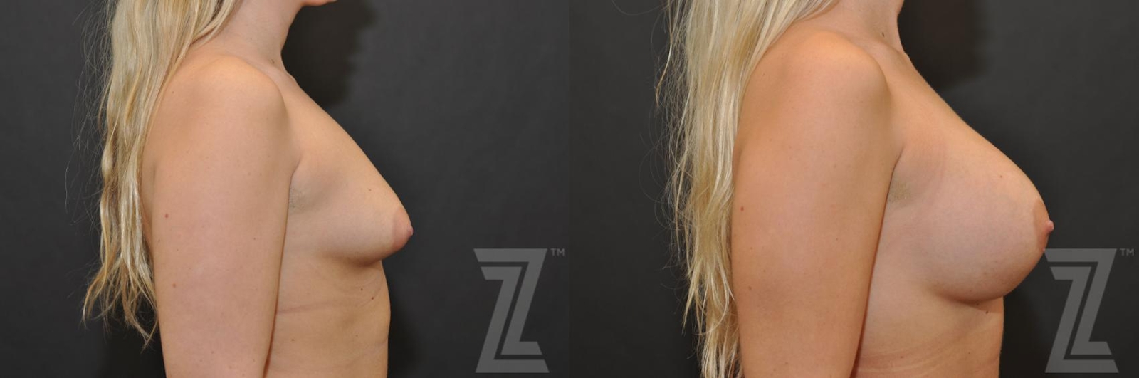 Austin Side view before & after images of 24 year old woman with Silicone Implants with Cohesive Silicone Gel - Dr. Rocco Piazza - The Piazza Center