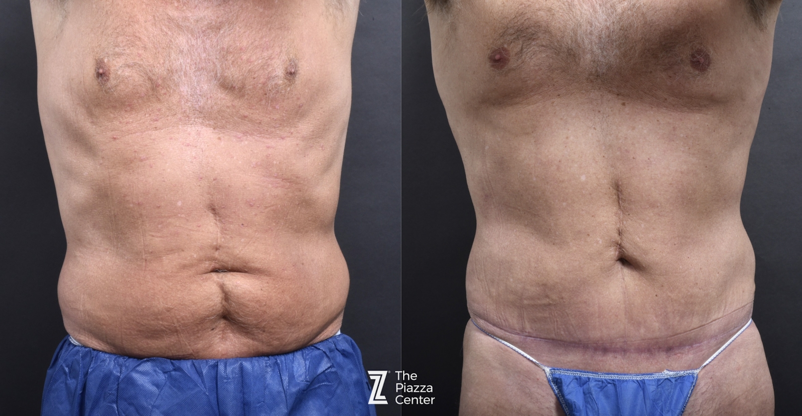 Austin Liposuction Before & After Gallery - Patient 182165 - Image 1 - The Piazza Center