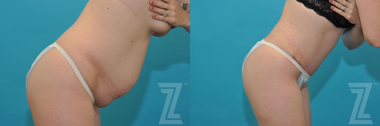 Austin Tummy Tuck Before & After Gallery - Patient 132886890 - Image 5 - The Piazza Center