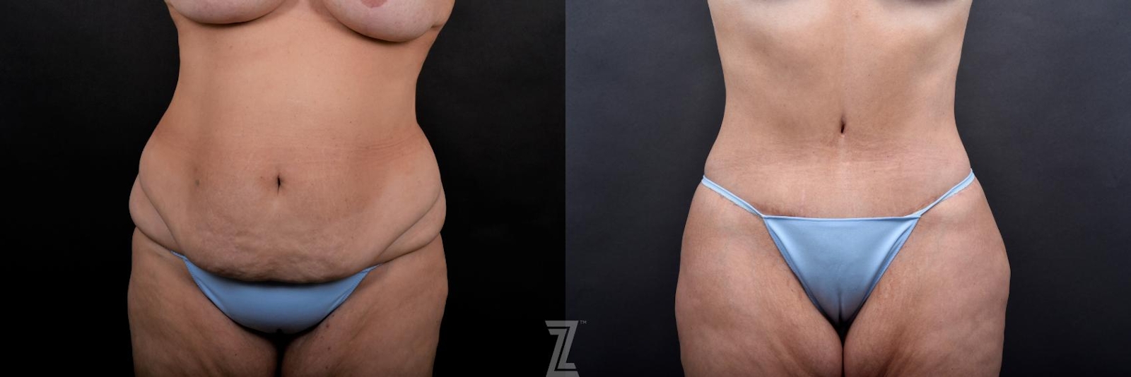 Austin Tummy Tuck Before & After Gallery - Patient 132886815 - Image 1 - The Piazza Center