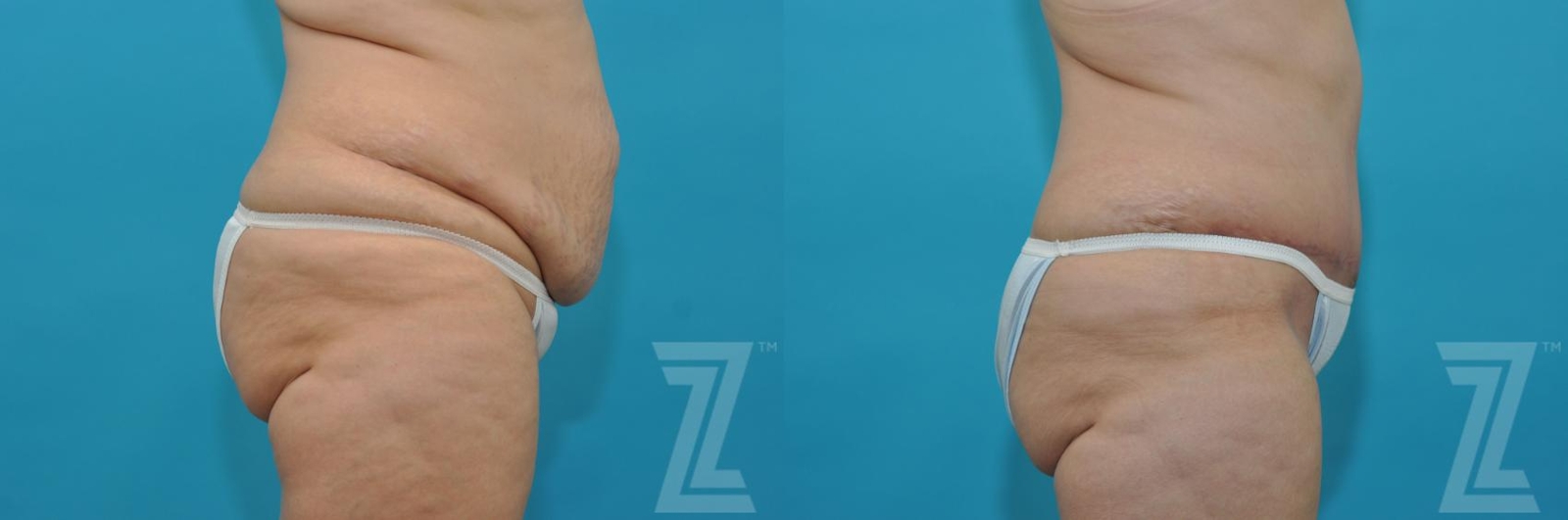 Austin Tummy Tuck Before & After Gallery - Patient 132886829 - Image 4 - The Piazza Center