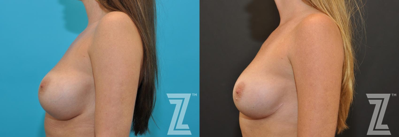 Austin Breast Augmentation Revision Before & After Gallery - Patient 132886561 - Image 3 - The Piazza Center