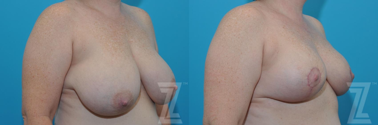 Austin Breast Reduction Before & After Gallery - Patient 132886606 - Image 4 - The Piazza Center