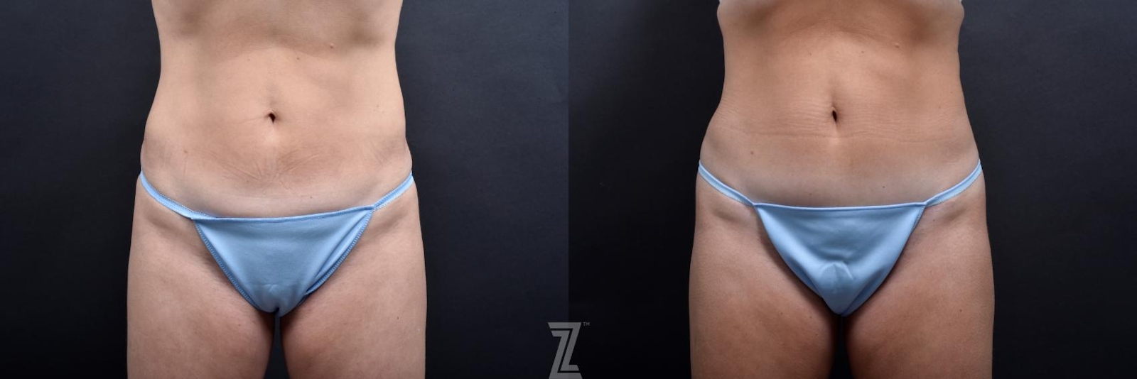 Austin Skin Pinch Before & After Gallery - Patient 132886939 - Image 1 - The Piazza Center